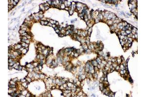 Anti- TRAP1 Picoband antibody, IHC(P) IHC(P): Human Intestinal Cancer Tissue (TRAP1 抗体  (AA 571-704))