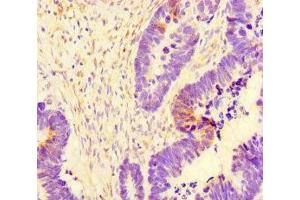 Immunohistochemistry of paraffin-embedded human ovarian cancer using ABIN7171154 at dilution of 1:100 (SYT1 抗体  (AA 301-523))