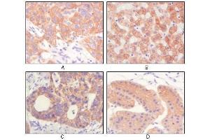 Immunohistochemical analysis of paraffin-embedded human lung squamous cell carcinoma (A),normal hepatocyte (B), colon adenocacinoma, normal stomach tissue (D), showing cytoplasmic and membrane localization using CK antibody with DAB staining. (pan Keratin 抗体)