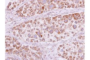 IHC-P Image PSKH1 antibody detects PSKH1 protein at cytooplasm and membrane on human liver carcinoma by immunohistochemical analysis. (PSKH1 抗体)