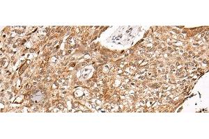 Immunohistochemistry of paraffin-embedded Human lung cancer tissue using C14orf169 Polyclonal Antibody at dilution of 1:45(x200) (C14orf169 + NO66 抗体)
