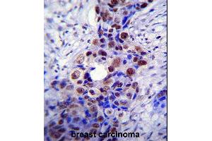 HDAC2 Antibody (C-term) (ABIN6242378 and ABIN6577318) immunohistochemistry analysis in formalin fixed and paraffin embedded human breast carcinoma followed by peroxidase conjugation of the secondary antibody and DAB staining. (HDAC2 抗体  (C-Term))