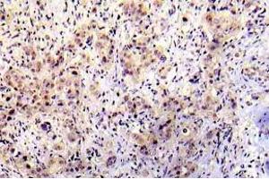 Immunohistochemistry (IHC) analyzes of p-P53 antibody in paraffin-embedded human breast carcinoma tissue. (p53 抗体  (pSer20))