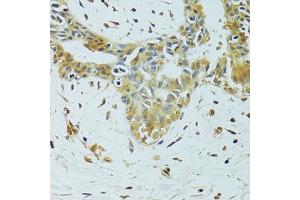 Immunohistochemistry of paraffin-embedded human breast cancer using METTL13 antibody. (METTL13 抗体)