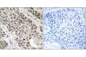 Immunohistochemistry analysis of paraffin-embedded human lung carcinoma tissue, using TNNI3K Antibody. (TNNI3K 抗体  (AA 301-350))