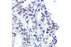 Immunohistochemistry of paraffin-embedded human colon carcinoma using Ku70 Rabbit mAb (ABIN7271407) at dilution of 1:100 (40x lens). (XRCC6 抗体)