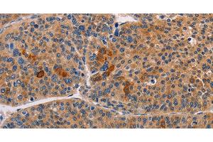 Immunohistochemistry of paraffin-embedded Human liver cancer using ALDH3A1 Polyclonal Antibody at dilution of 1:55 (ALDH3A1 抗体)