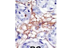 Formalin-fixed and paraffin-embedded human cancer tissue reacted with the primary antibody, which was peroxidase-conjugated to the secondary antibody, followed by DAB staining. (PIP4K2A 抗体  (N-Term))