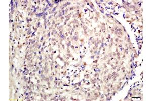 Formalin-fixed and paraffin embedded human laryngeal tissue labeled with Rabbit Anti-KDM5A Polyclonal Antibody, Unconjugated (ABIN2177121) at 1:200 followed by conjugation to the secondary antibody and DAB staining (KDM5A 抗体  (AA 101-200))