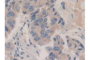 Detection of CHGB in Human Breast cancer Tissue using Polyclonal Antibody to Chromogranin B (CHGB) (CHGB 抗体  (AA 496-669))