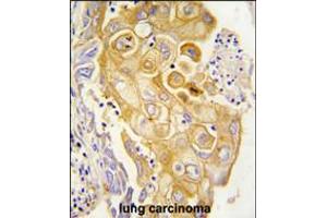 Formalin-fixed and paraffin-embedded human lung carcinoma tissue reacted with CYP8A1 antibody , which was peroxidase-conjugated to the secondary antibody, followed by DAB staining. (PTGIS 抗体  (N-Term))