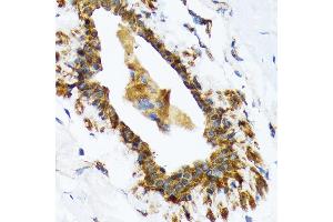 Immunohistochemistry of paraffin-embedded human breast using RAIDD/CRADD Rabbit mAb (ABIN7266107) at dilution of 1:100 (40x lens). (CRADD 抗体)