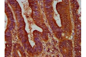 IHC image of ABIN7144528 diluted at 1:500 and staining in paraffin-embedded human colon cancer performed on a Leica BondTM system. (ALOX12 抗体  (AA 508-658))