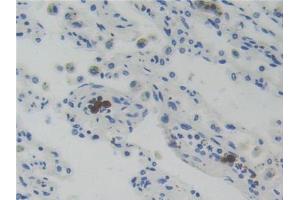 DAB staining on IHC-P; Samples: Human Lung Cancer Tissue (Glucocorticoid Receptor 抗体  (AA 598-755))