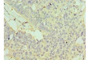 Immunohistochemistry of paraffin-embedded human endometrial cancer using ABIN7154113 at dilution of 1:100 (GSTO2 抗体  (AA 124-243))