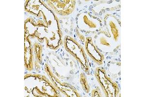 Immunohistochemistry of paraffin-embedded human kidney cancer using GLRX Antibody (ABIN6127980, ABIN6141147, ABIN6141149 and ABIN6220940) at dilution of 1:200 (40x lens). (Glutaredoxin 1 抗体  (AA 1-106))