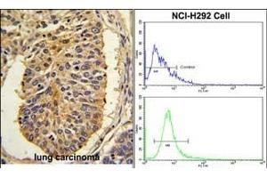 (LEFT)Formalin-fixed and paraffin-embedded human lung carcinoma with CER1 Antibody (N-term), which was peroxidase-conjugated to the secondary antibody, followed by DAB staining. (CER1 抗体  (N-Term))