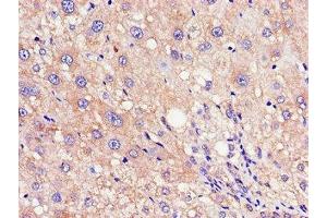 Immunohistochemistry of paraffin-embedded human liver cancer using ABIN7168030 at dilution of 1:100 (RND3 抗体  (AA 152-239))