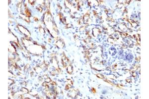 Formalin-fixed, paraffin-embedded human Angiosarcoma stained with CD31 Rabbit Polyclonal Antibody. (CD31 抗体)