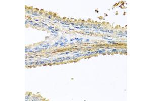 Immunohistochemistry of paraffin-embedded human prostate using PIP antibody (ABIN5973796) at dilution of 1/100 (40x lens). (PIP 抗体)