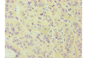 Immunohistochemistry of paraffin-embedded human liver cancer using ABIN7149265 at dilution of 1:100 (CYP3A5 抗体  (AA 233-502))