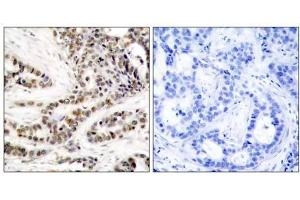 Immunohistochemical analysis of paraffin-embedded human breast carcinoma tissue using CREB (phospho-Ser129) antibody (E011273). (CREB1 抗体  (pSer129))