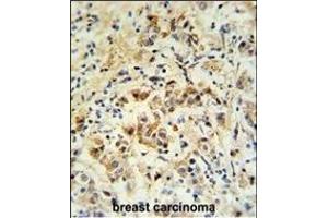 mouse BID Antibody (S61) (ABIN388100 and ABIN2846184) IHC analysis in formalin fixed and paraffin embedded human breast carcinoma followed by peroxidase conjugation of the secondary antibody and DAB staining. (BID 抗体  (AA 39-68))