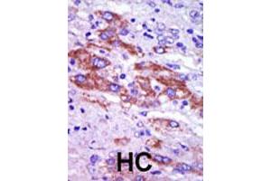 Formalin-fixed and paraffin-embedded human hepatocellular carcinoma tissue reacted with CSNK1D polyclonal antibody  , which was peroxidase-conjugated to the secondary antibody, followed by DAB staining. (Casein Kinase 1 delta 抗体  (C-Term))