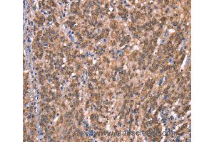 Immunohistochemistry of Human liver cancer using GCSAM Polyclonal Antibody at dilution of 1:40 (GCET2 抗体)