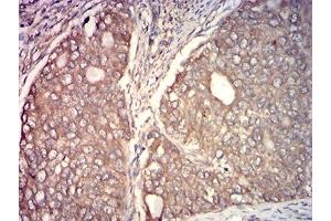 Immunohistochemical analysis of paraffin-embedded cervical cancer tissues using CAPN1 mouse mAb with DAB staining. (CAPNL1 抗体  (AA 501-714))