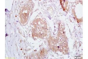 Formalin-fixed and paraffin embedded human breast carcinoma labeled with Anti-CD168/RHAMM Polyclonal Antibody, Unconjugated (ABIN1386755) at 1:200 followed by conjugation to the secondary antibody and DAB staining (HMMR 抗体  (AA 51-150))