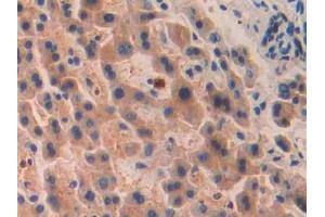 DAB staining on IHC-P; Samples: Human Liver cancer Tissue (PITRM1 抗体  (AA 544-806))