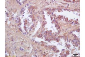 Formalin-fixed and paraffin embedded human lung carcinoma labeled with Rabbit Anti FIS1/TTC11 Polyclonal Antibody, Unconjugated (ABIN872461) at 1:200 followed by conjugation to the secondary antibody and DAB staining (Fission 1 抗体  (AA 55-152))