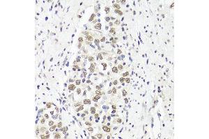 Immunohistochemistry of paraffin-embedded human esophageal cancer using PARP1 antibody at dilution of 1:100 (x40 lens). (PARP1 抗体)