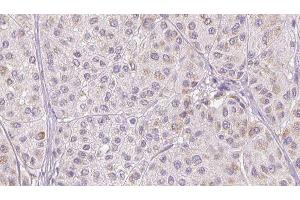 ABIN6277329 at 1/100 staining Human melanoma tissue by IHC-P. (CFHR1 抗体  (C-Term))