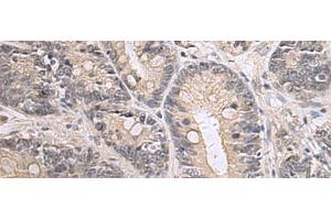 Immunohistochemistry of paraffin-embedded Human gastric cancer tissue using PPM1K Polyclonal Antibody at dilution of 1:55(x200) (PPM1K 抗体)