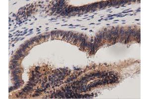 Immunohistochemical staining of paraffin-embedded Adenocarcinoma of Human ovary tissue using anti-PRKD2 mouse monoclonal antibody. (PKD2 抗体)