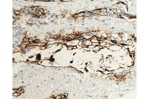 ABIN6277014 at 1/100 staining human lung carcinoma tissue sections by IHC-P. (ANGPTL4 抗体  (N-Term))