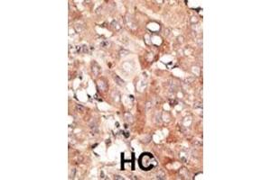 Formalin-fixed and paraffin-embedded human cancer tissue reacted with the primary antibody, which was peroxidase-conjugated to the secondary antibody, followed by DAB staining. (RGS19 抗体  (N-Term))