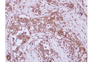 IHC-P Image Immunohistochemical analysis of paraffin-embedded human breast cancer, using P2X7, antibody at 1:250 dilution. (P2RX7 抗体  (Center))