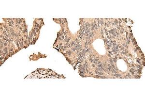 Immunohistochemistry of paraffin-embedded Human colorectal cancer tissue using ZSCAN12 Polyclonal Antibody at dilution of 1:50(x200) (ZSCAN12 抗体)