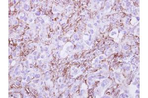 IHC-P Image G6PD antibody detects G6PD protein at cytosol on human breast cancer by immunohistochemical analysis. (Glucose-6-Phosphate Dehydrogenase 抗体)