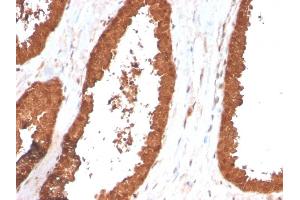 Formalin-fixed, paraffin-embedded human Prostate Carcinoma stained with TIGIT-Monospecific Mouse Monoclonal Antibody (TIGIT/3017). (TIGIT 抗体  (AA 22-141))