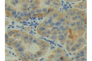 Detection of C2 in Human Liver cancer Tissue using Polyclonal Antibody to Complement Component 2 (C2) (Complement C2 抗体  (AA 245-451))