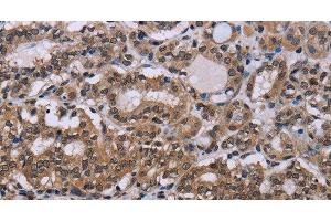 Immunohistochemistry of paraffin-embedded Human thyroid cancer tissue using DLX4 Polyclonal Antibody at dilution 1:50 (DLX4 抗体)