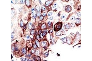 IHC analysis of FFPE human cancer tissue stained with the AXL antibody (AXL 抗体  (AA 863-894))