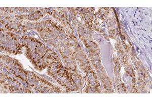 ABIN6267081 at 1/100 staining Human thyroid cancer tissue by IHC-P.