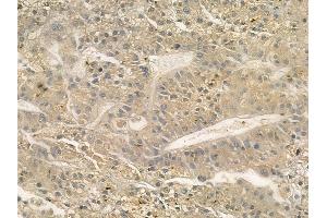 ABIN6262074 and ABIN6272312 at 1/100 staining human hepatocellular carcinoma by IHC-P. (GRAP 抗体  (C-Term))
