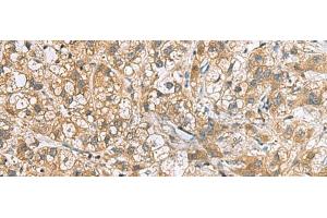Immunohistochemistry of paraffin-embedded Human liver cancer tissue using DNPH1 Polyclonal Antibody at dilution of 1:60(x200) (RCL 抗体)