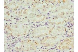 Immunohistochemistry of paraffin-embedded human gastric cancer using ABIN7153264 at dilution of 1:100 (FGD5 抗体  (AA 1203-1462))